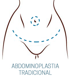 O QUE É ABDOMINOPLASTIA TRADICIONAL