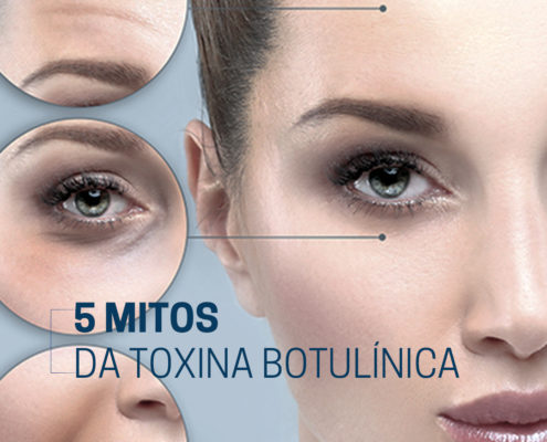 Como é um procedimento famoso que abre discussões por onde passa, é normal que muitos mitos sejam reproduzidos. Por isso, separamos os 5 mitos sobre a Toxina Botulínica: